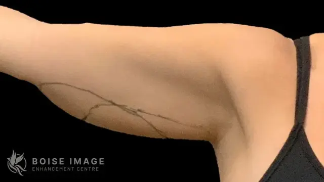 Liposuction before at Boise Image Enhancement Center, Inc in Boise, ID