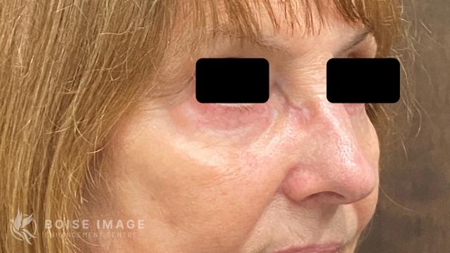 Blepharoplasty after at Boise Image Enhancement Center, Inc in Boise, ID