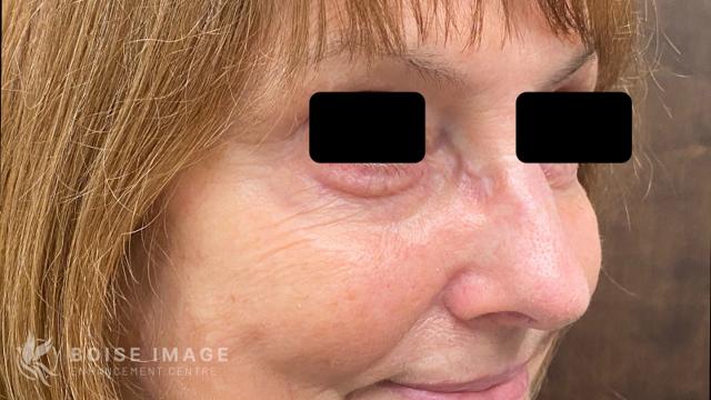 Blepharoplasty before at Boise Image Enhancement Center, Inc in Boise, ID