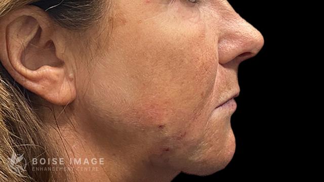 Jawline Filler after at Boise Image Enhancement Center, Inc in Boise, ID