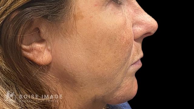 Jawline Filler before at Boise Image Enhancement Center, Inc in Boise, ID