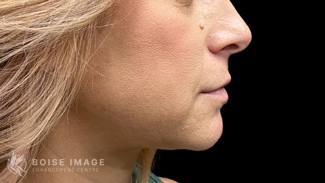 Jawline Filler after at Boise Image Enhancement Center, Inc in Boise, ID