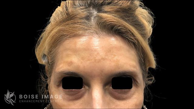 Botox after at Boise Image Enhancement Center, Inc in Boise, ID