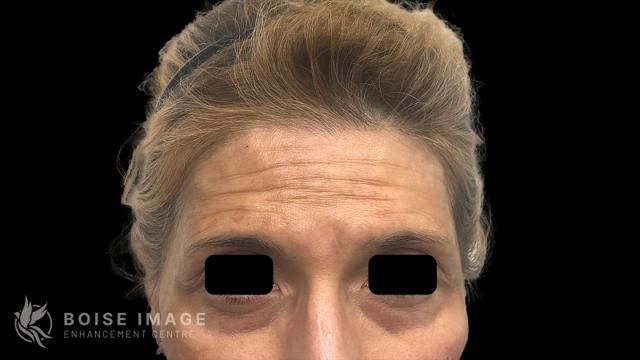 Botox before at Boise Image Enhancement Center, Inc in Boise, ID