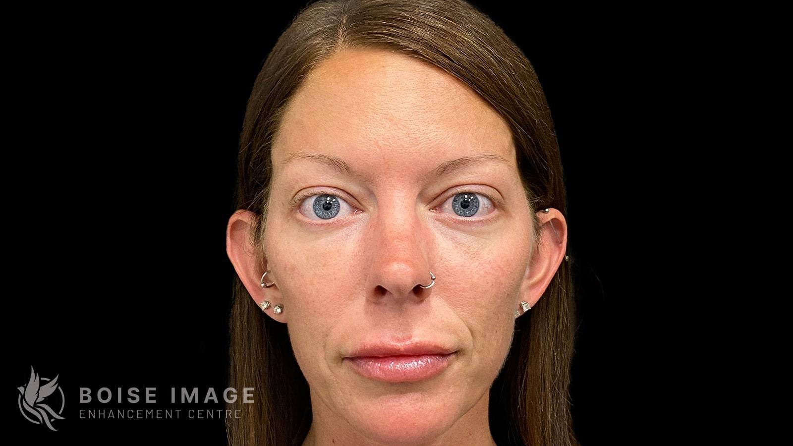 Boise Image Enhancement Center, Inc cheek filler after — Boise, ID