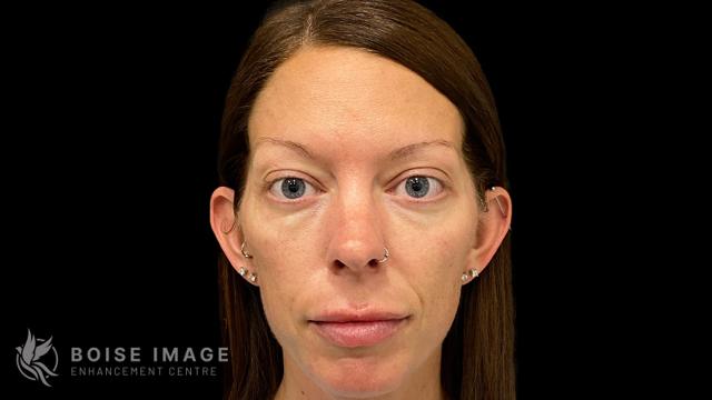 Juvederm before at Boise Image Enhancement Center, Inc in Boise, ID