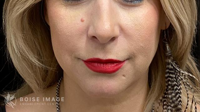 Lip Filler after at Boise Image Enhancement Center, Inc in Boise, ID