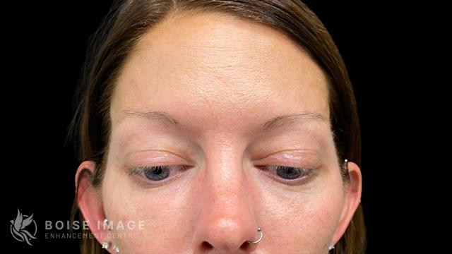 Blepharoplasty after at Boise Image Enhancement Center, Inc in Boise, ID