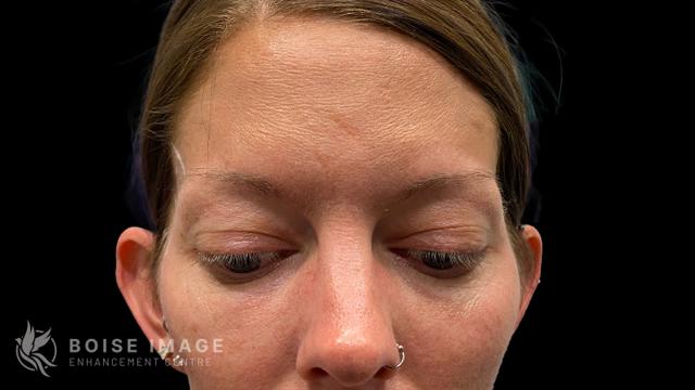 Blepharoplasty before at Boise Image Enhancement Center, Inc in Boise, ID