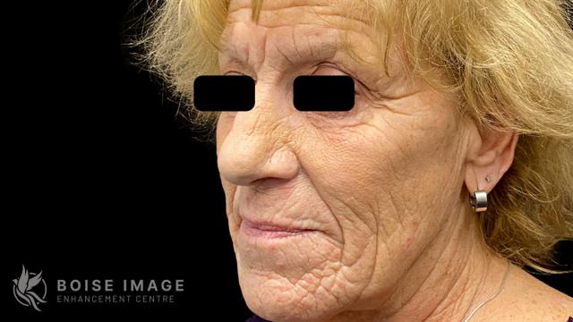 Mini Facelift before at Boise Image Enhancement Center, Inc in Boise, ID