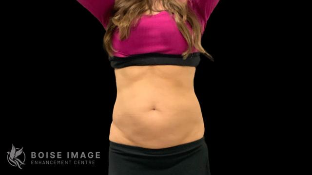Liposuction after at Boise Image Enhancement Center, Inc in Boise, ID