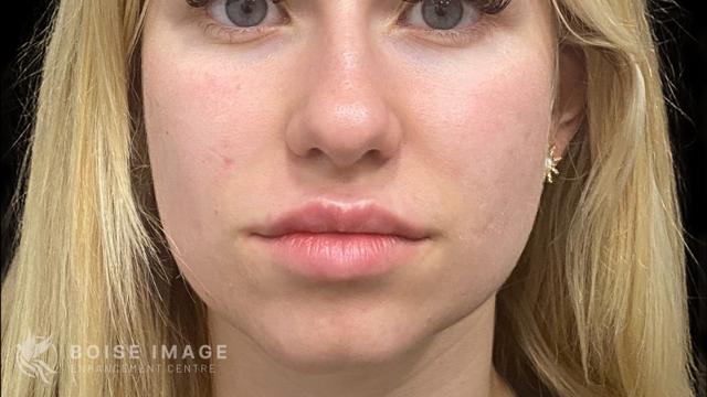 Lip Filler after at Boise Image Enhancement Center, Inc in Boise, ID