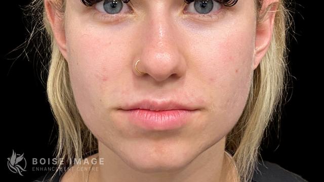 Lip Filler before at Boise Image Enhancement Center, Inc in Boise, ID
