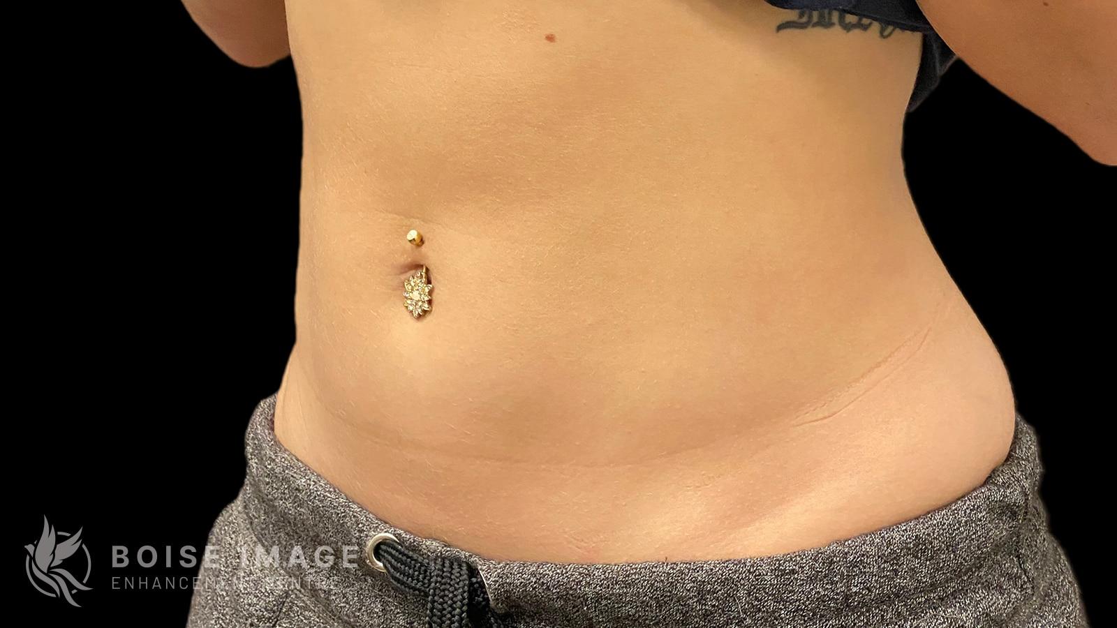 Boise Image Enhancement Center, Inc liposuction after — Boise, ID