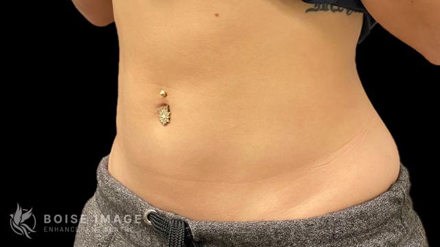 Liposuction after at Boise Image Enhancement Center, Inc in Boise, ID