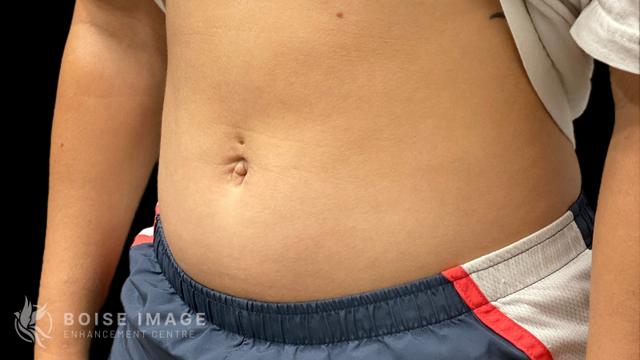 Liposuction before at Boise Image Enhancement Center, Inc in Boise, ID