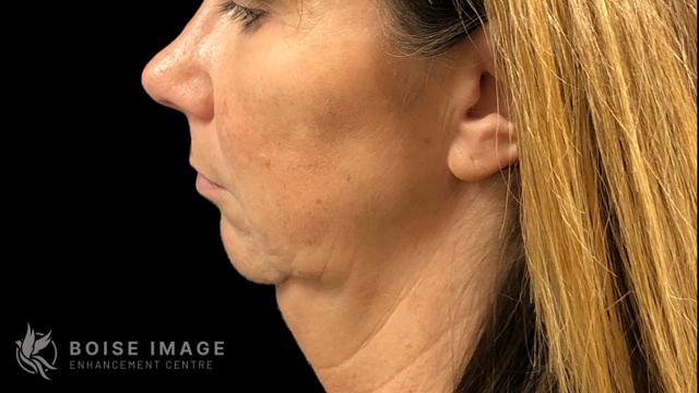 Jawline Filler before at Boise Image Enhancement Center, Inc in Boise, ID