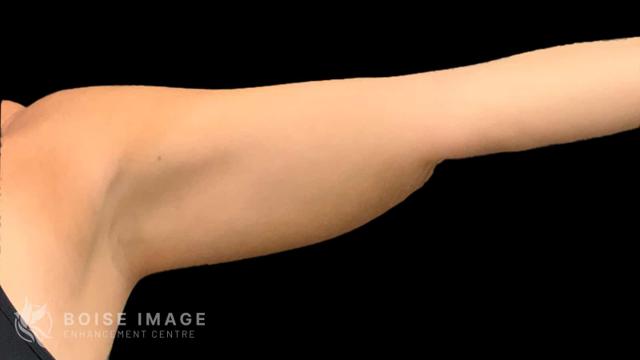 Liposuction after at Boise Image Enhancement Center, Inc in Boise, ID