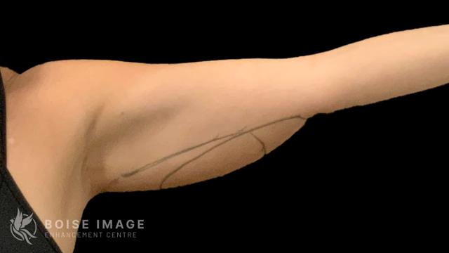 Liposuction before at Boise Image Enhancement Center, Inc in Boise, ID
