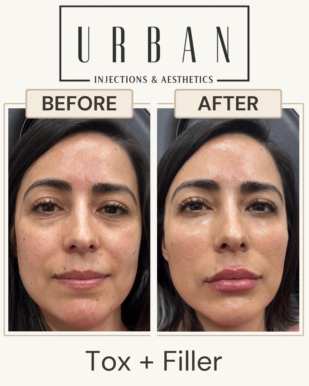 Urban Injections & Aesthetics lip filler result — Syracuse, UT