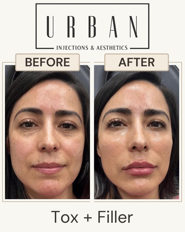 Lip Filler result at Urban Injections & Aesthetics in Syracuse, UT