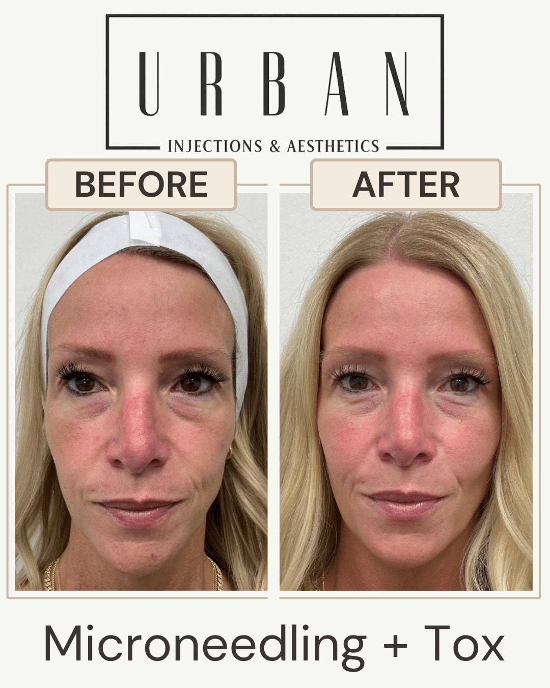 Urban Injections & Aesthetics microneedling result — Syracuse, UT