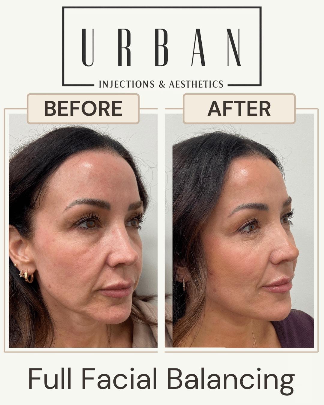 Urban Injections & Aesthetics jawline filler result — Syracuse, UT