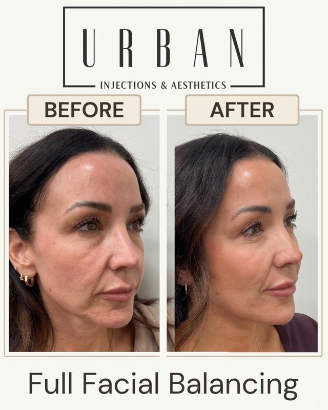 Jawline Filler result at Urban Injections & Aesthetics in Syracuse, UT