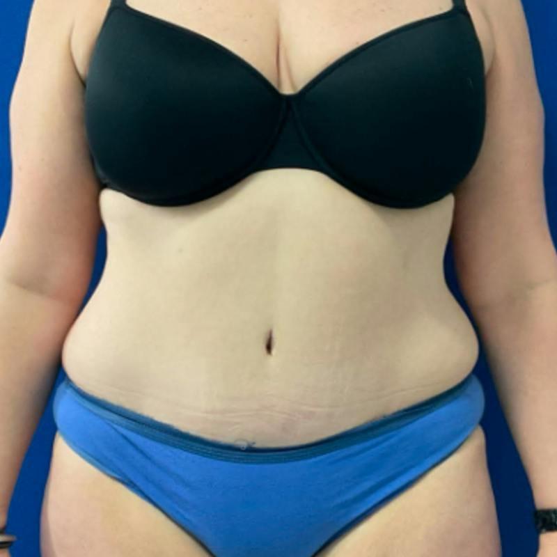 Coleman Brown Plastic Surgery tummy tuck after — Chevy Chase, MD