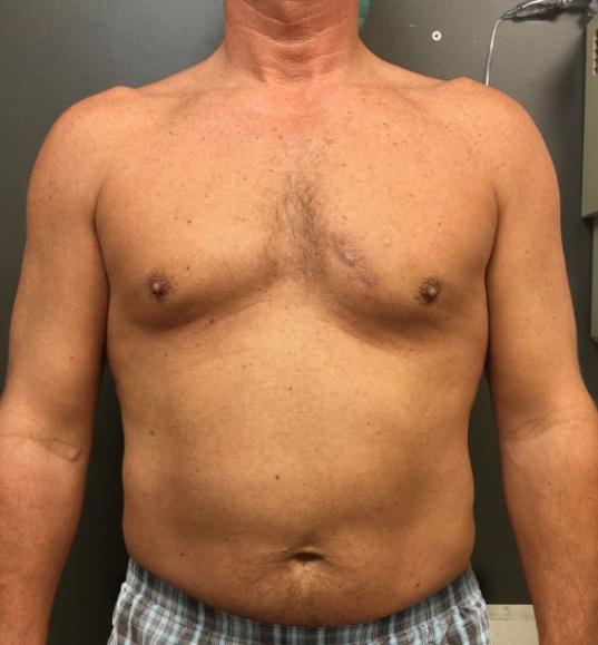 Gynecomastia Surgery before at Wiesman Cosmetic Surgery in Chicago, IL