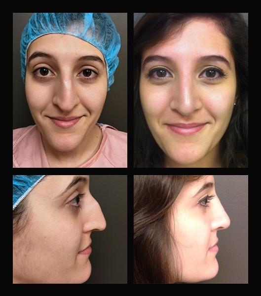 Rhinoplasty result at Wiesman Cosmetic Surgery in Chicago, IL