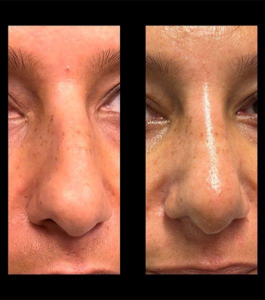 Rhinoplasty result at Wiesman Cosmetic Surgery in Chicago, IL