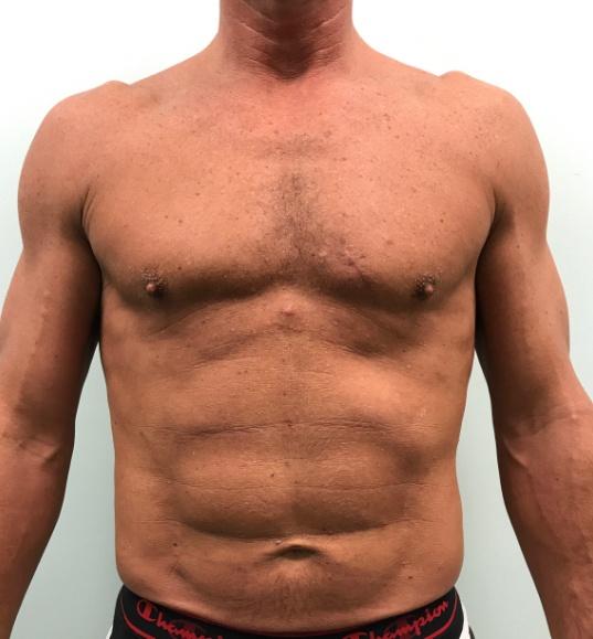 Gynecomastia Surgery after at Wiesman Cosmetic Surgery in Chicago, IL