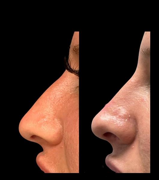 Rhinoplasty result at Wiesman Cosmetic Surgery in Chicago, IL