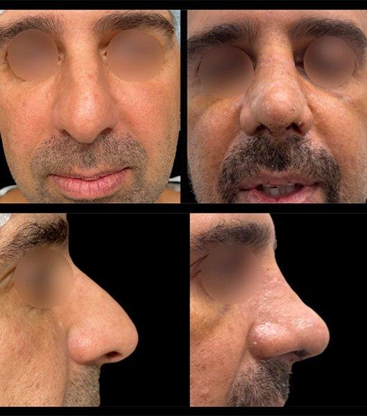 Rhinoplasty result at Wiesman Cosmetic Surgery in Chicago, IL