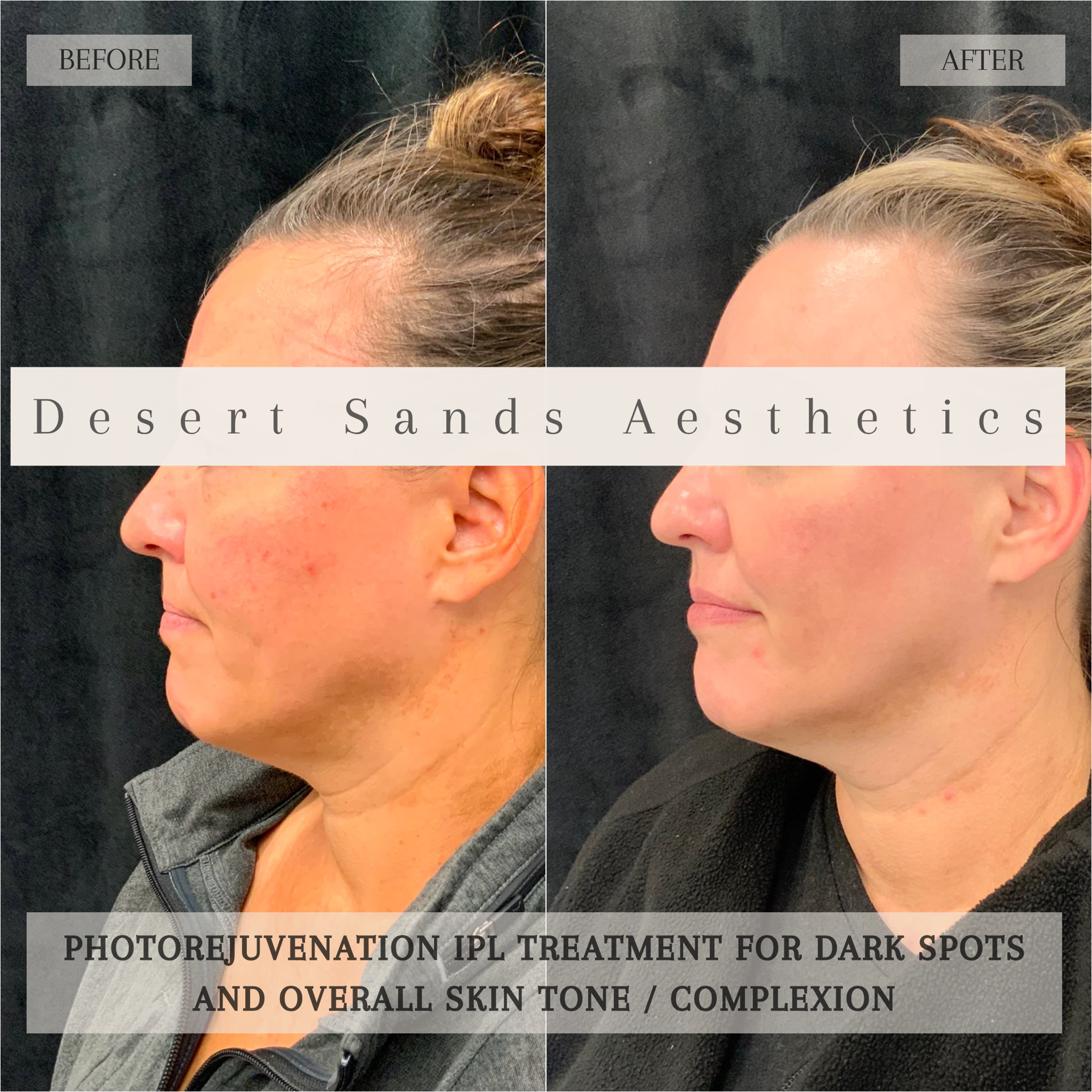 Desert Sands Aesthetics & Laser result — St. George, UT