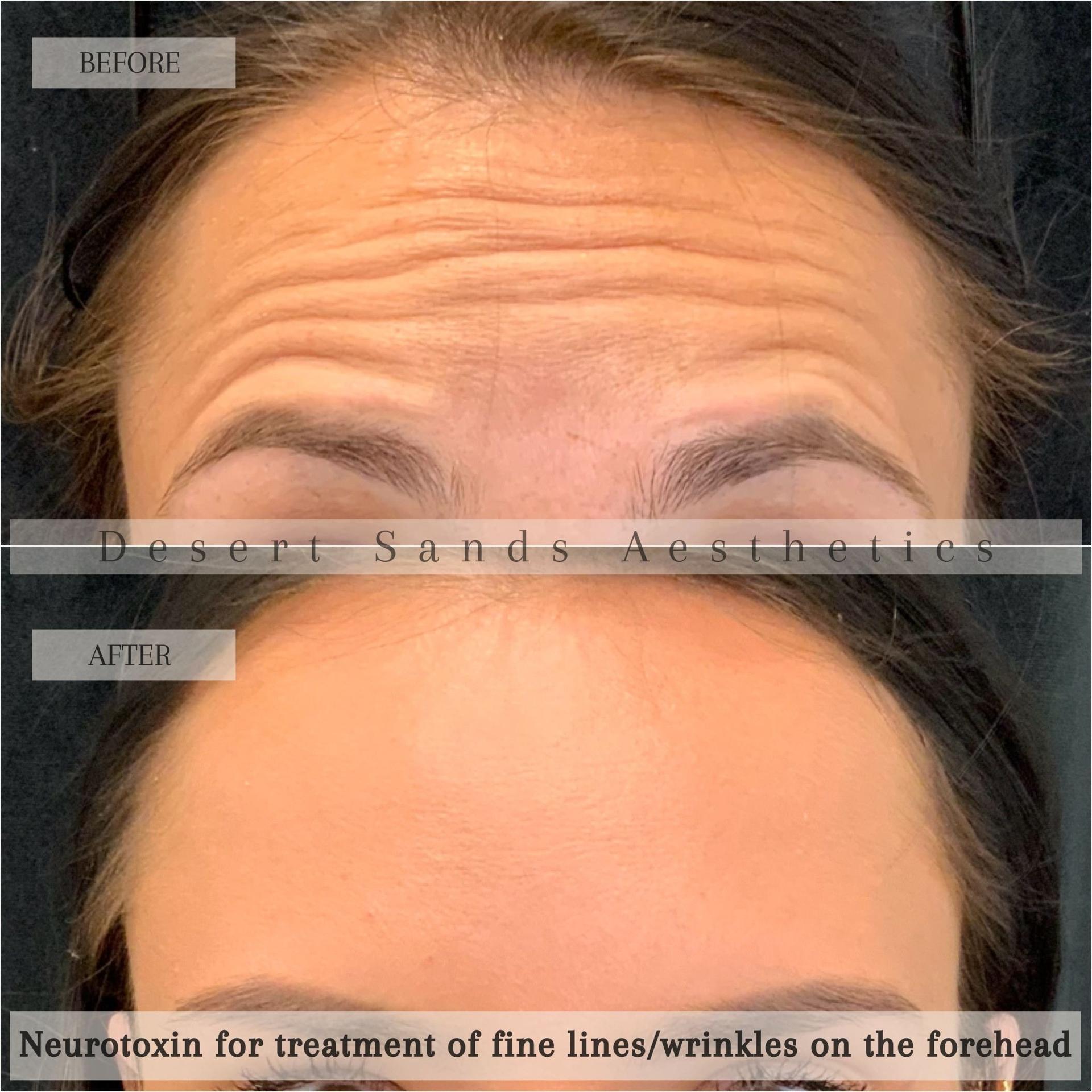 Desert Sands Aesthetics & Laser botox result — St. George, UT