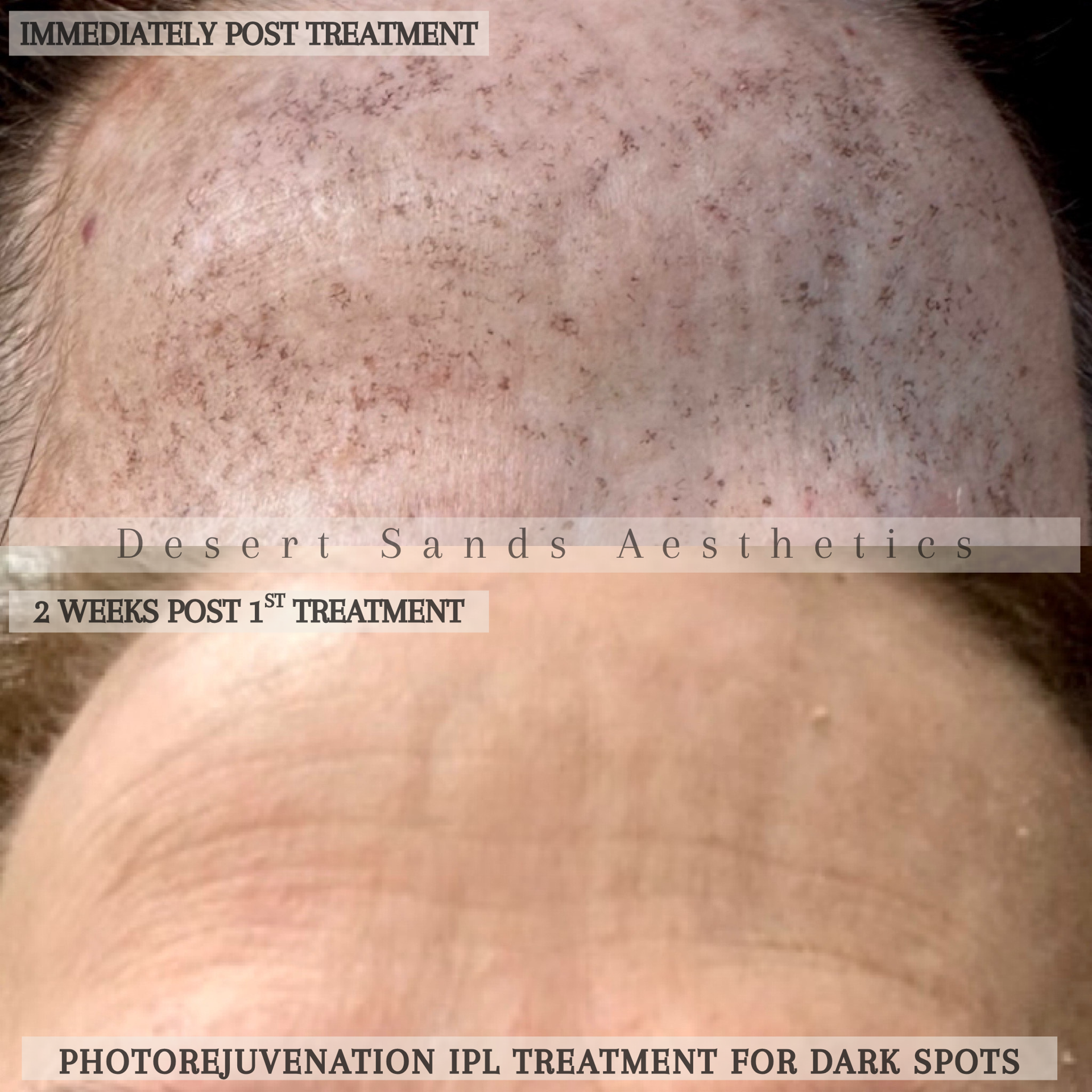 Desert Sands Aesthetics & Laser result — St. George, UT