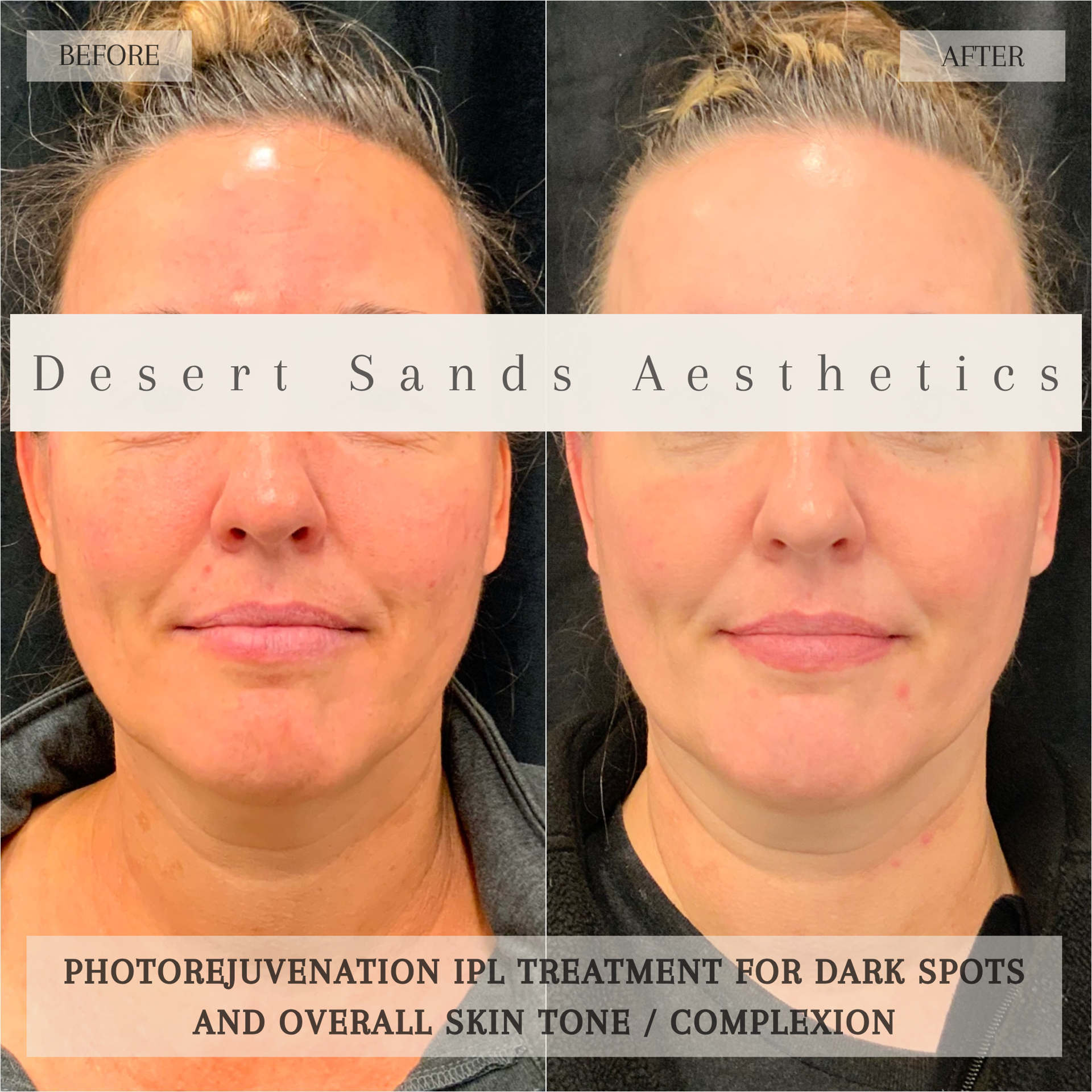 Desert Sands Aesthetics & Laser result — St. George, UT