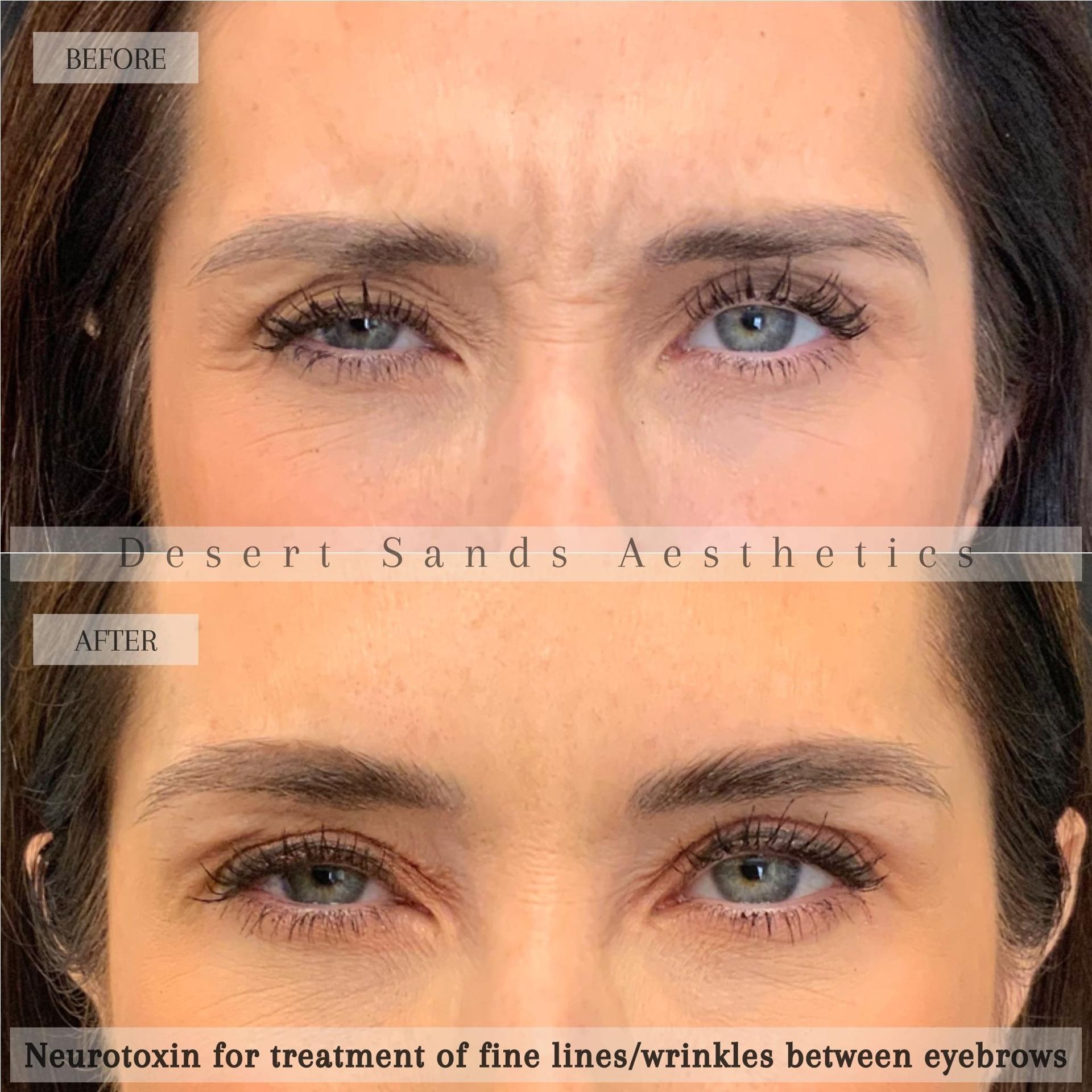 Desert Sands Aesthetics & Laser botox result — St. George, UT