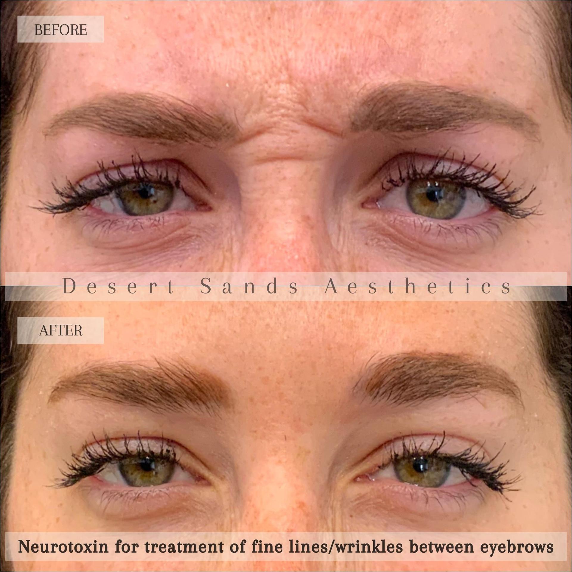 Desert Sands Aesthetics & Laser botox result — St. George, UT