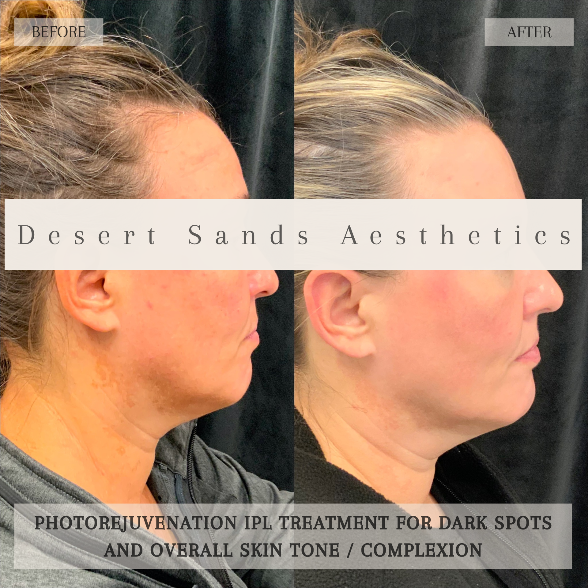 Desert Sands Aesthetics & Laser result — St. George, UT