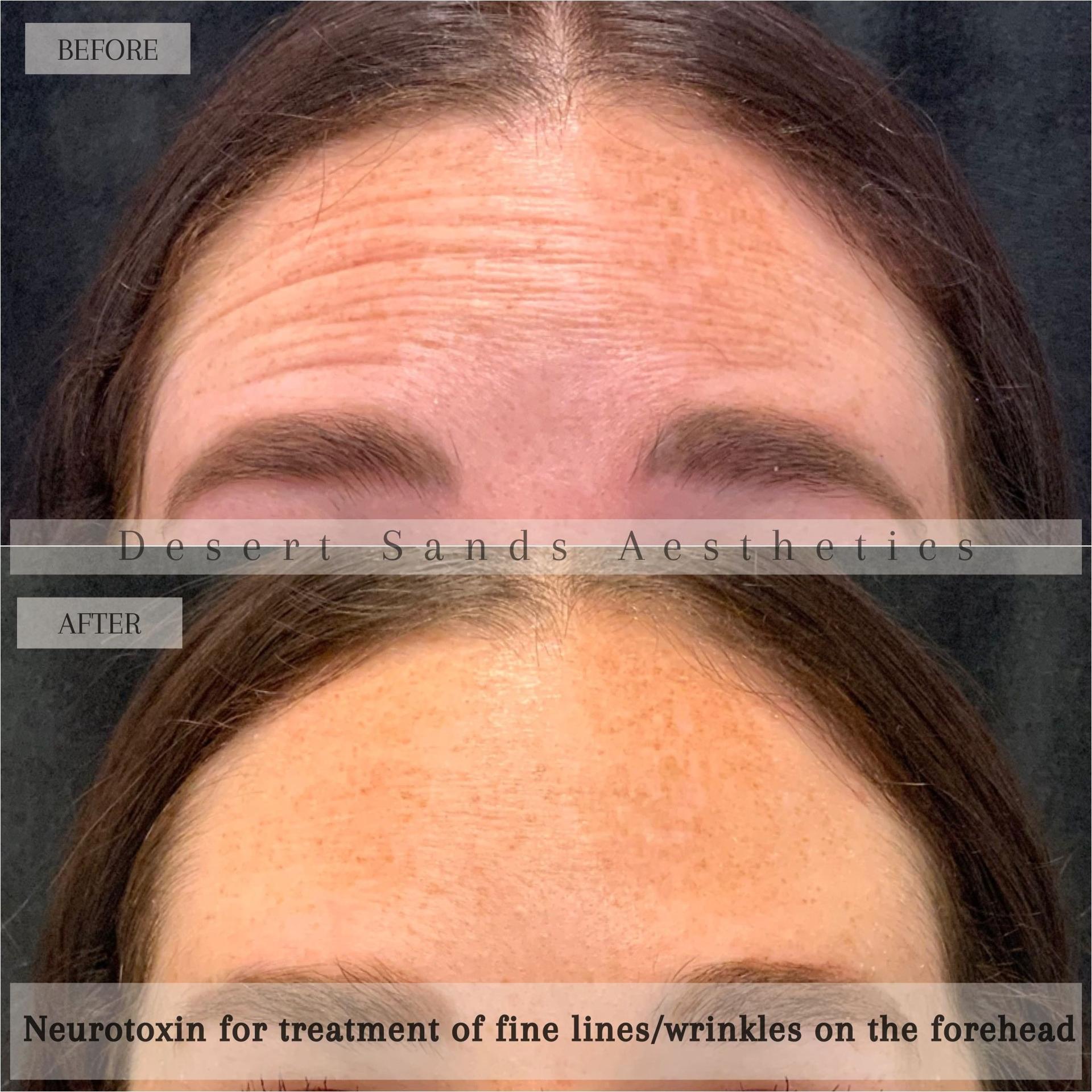 Desert Sands Aesthetics & Laser botox result — St. George, UT