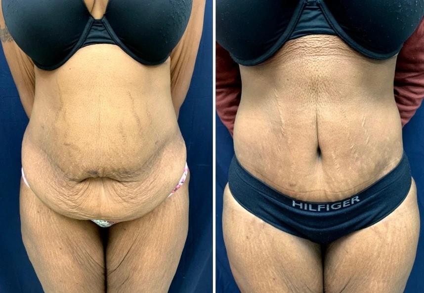 Murray Hill Plastic Surgery & Vein Center mommy makeover result — New York, NY
