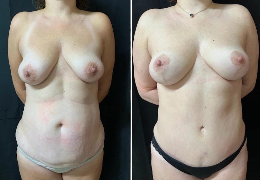 Murray Hill Plastic Surgery & Vein Center mommy makeover result — New York, NY