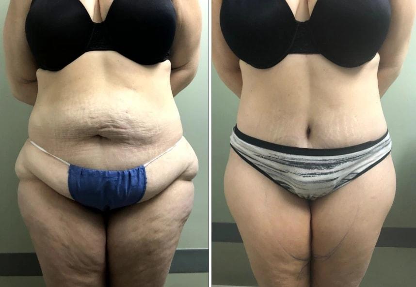 Murray Hill Plastic Surgery & Vein Center mommy makeover result — New York, NY