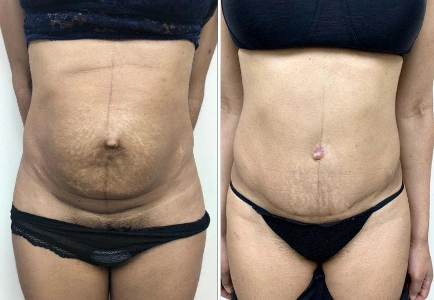 Murray Hill Plastic Surgery & Vein Center mommy makeover result — New York, NY