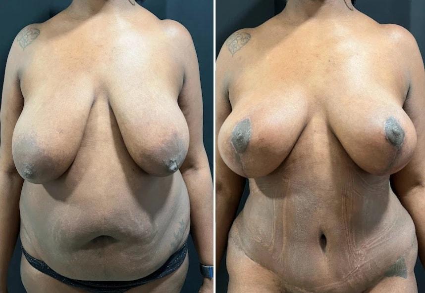 Murray Hill Plastic Surgery & Vein Center mommy makeover result — New York, NY