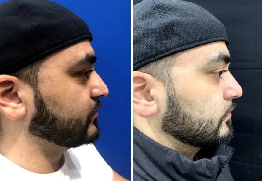 Murray Hill Plastic Surgery & Vein Center rhinoplasty result — New York, NY