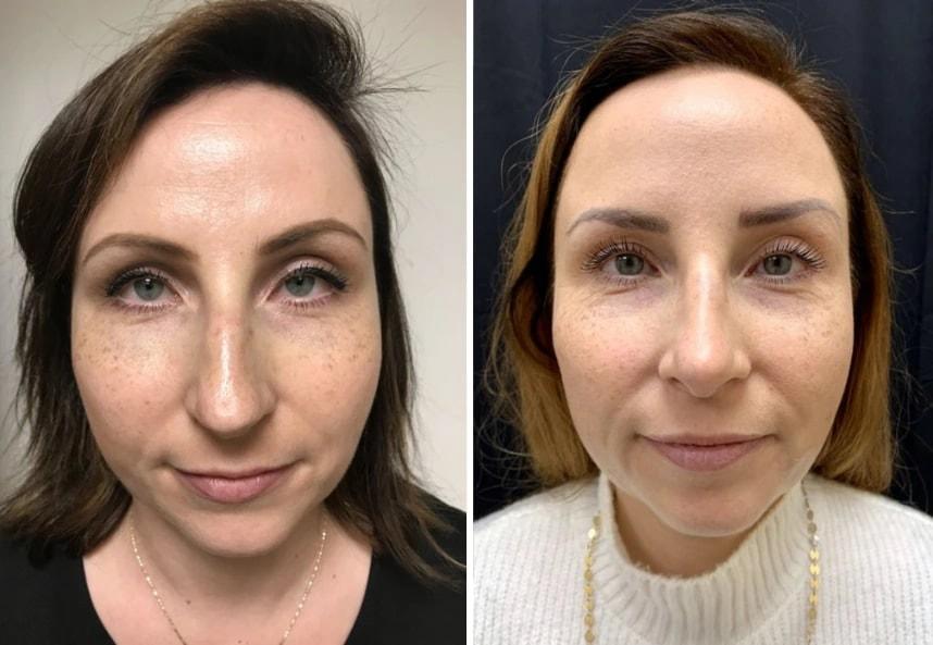 Murray Hill Plastic Surgery & Vein Center rhinoplasty result — New York, NY
